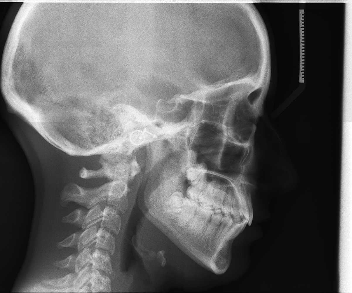 RADIOGRAFIA CEFALOMETRICA