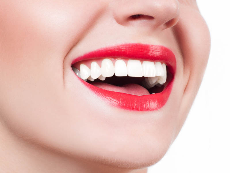 Consulenza estetica dentale e sbiancamento denti Teramo e provincia