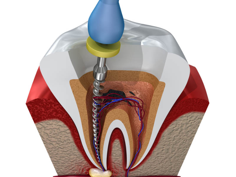 Endodonzia Devitalizzazione denti Teramo e provincia