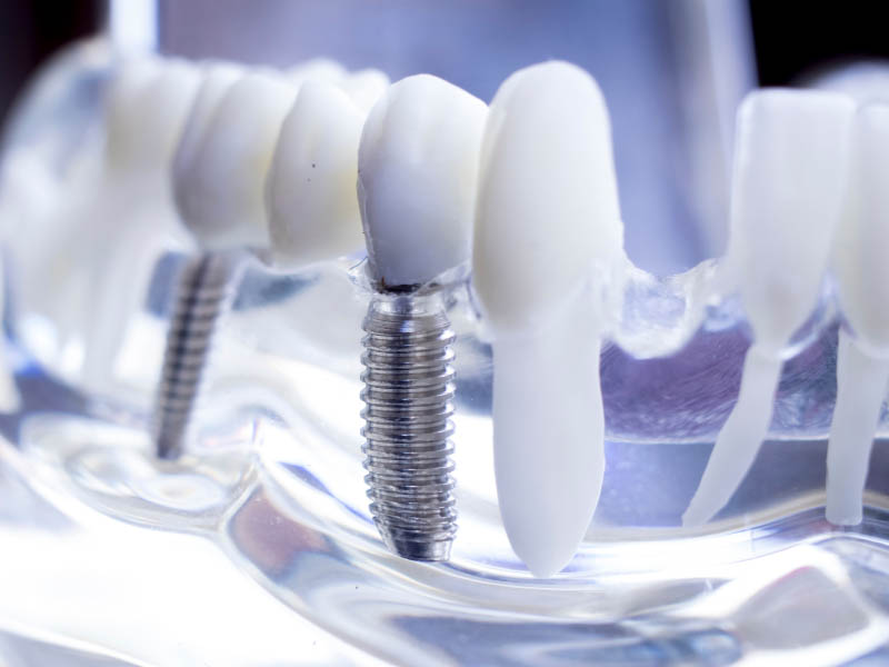 Implantologia dentale e chirurgia computer-guidata Teramo e provincia