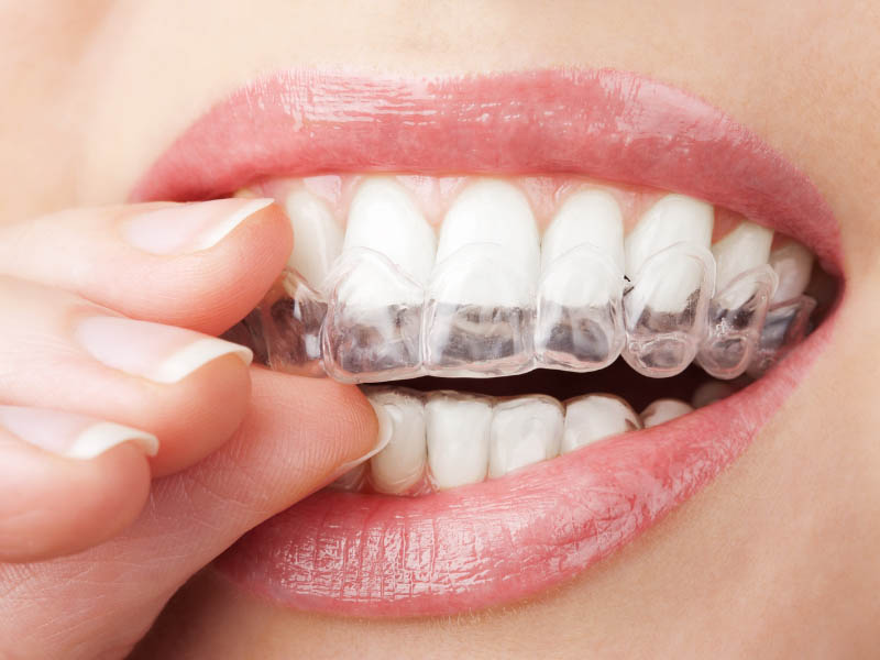 Ortodonzia invisibile Apparecchio dentale trasparente Teramo e provincia